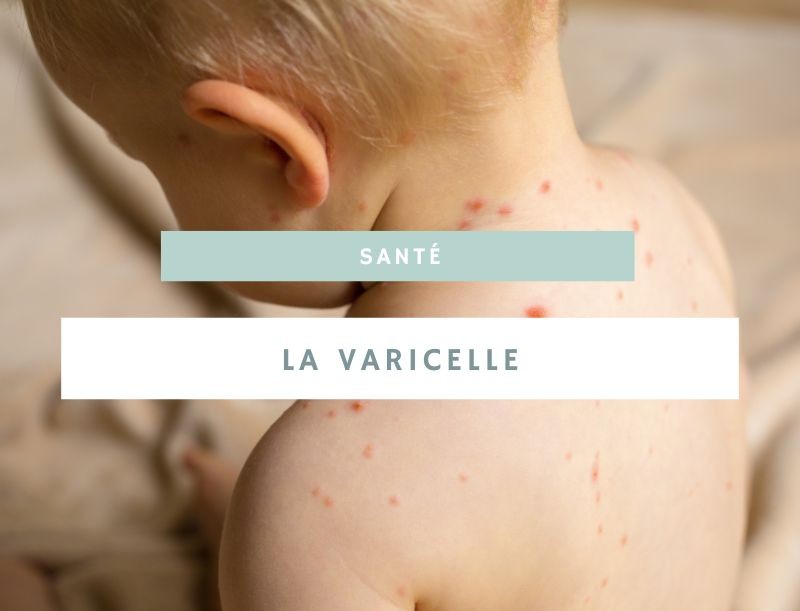 Zoom sur la varicelle de bébé