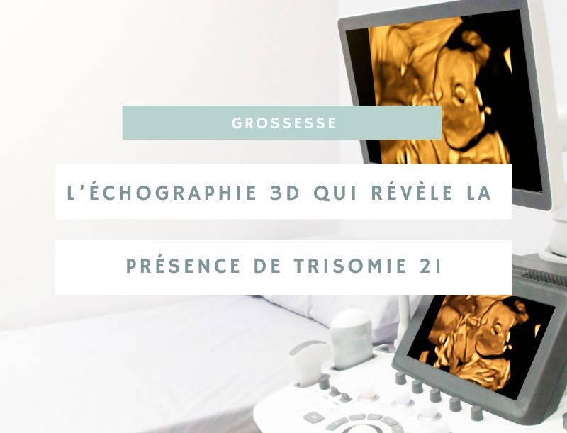 Le diagnostic de la trisomie 21 grâce à l'échographie 3D
