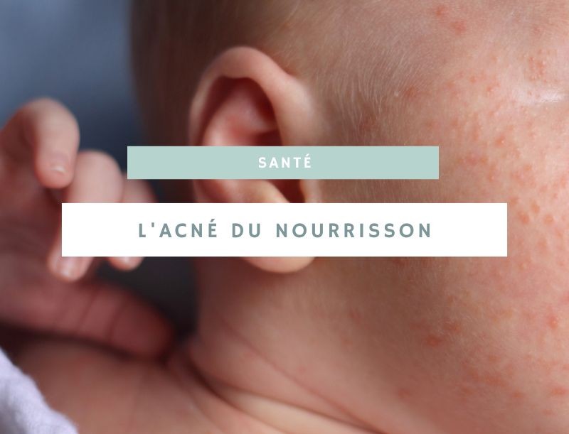 Acné du nourrisson : comprendre et gérer cette affection cutanée courante